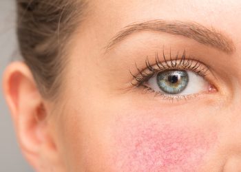 Lice mi se zacrveni i bukne. Zašto se stanje pogoršava s godinama?