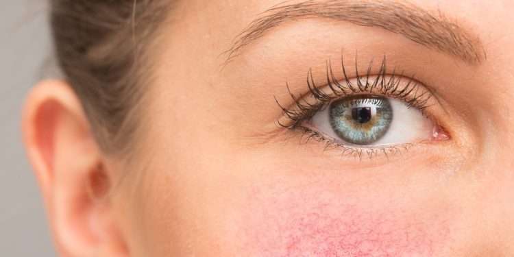 Lice mi se zacrveni i bukne. Zašto se stanje pogoršava s godinama?